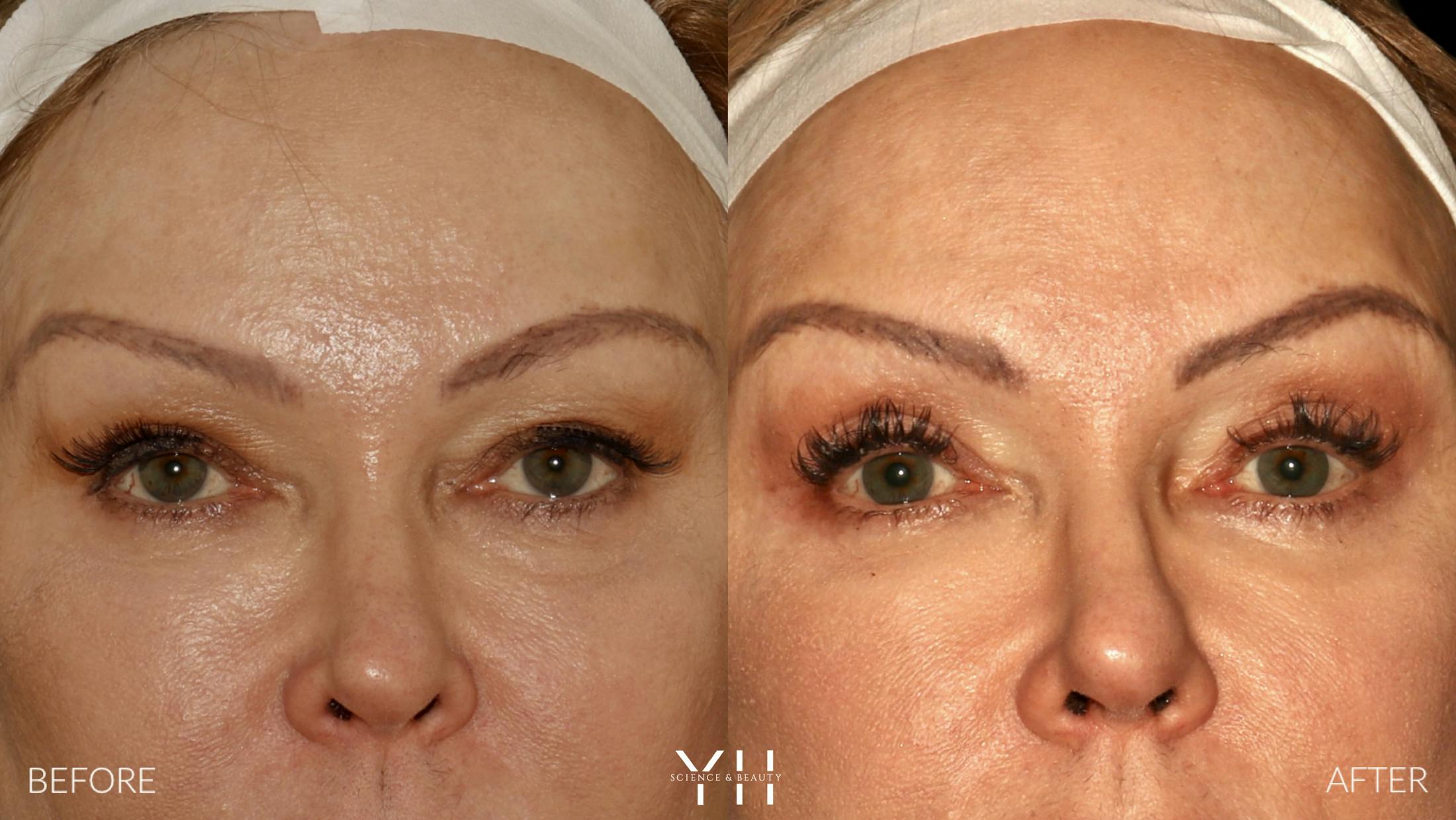 Blepharoplasty Before & After Gallery - Patient 328344 - Image 1