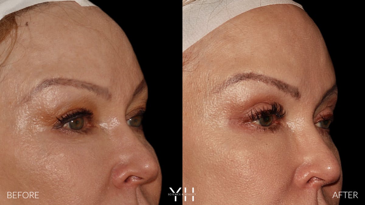 Blepharoplasty Before & After Gallery - Patient 328344 - Image 2