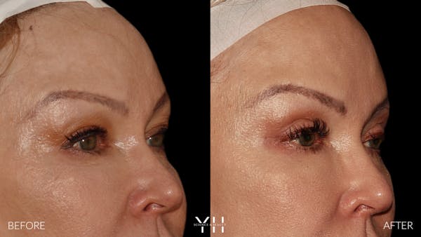  Blepharoplasty Before & After Gallery - Patient 328344 - Image 2