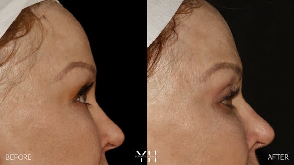  Blepharoplasty Before & After Gallery - Patient 328344 - Image 3