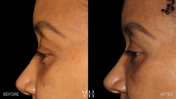 Blepharoplasty Before & After Gallery - Patient 746491 - Image 3