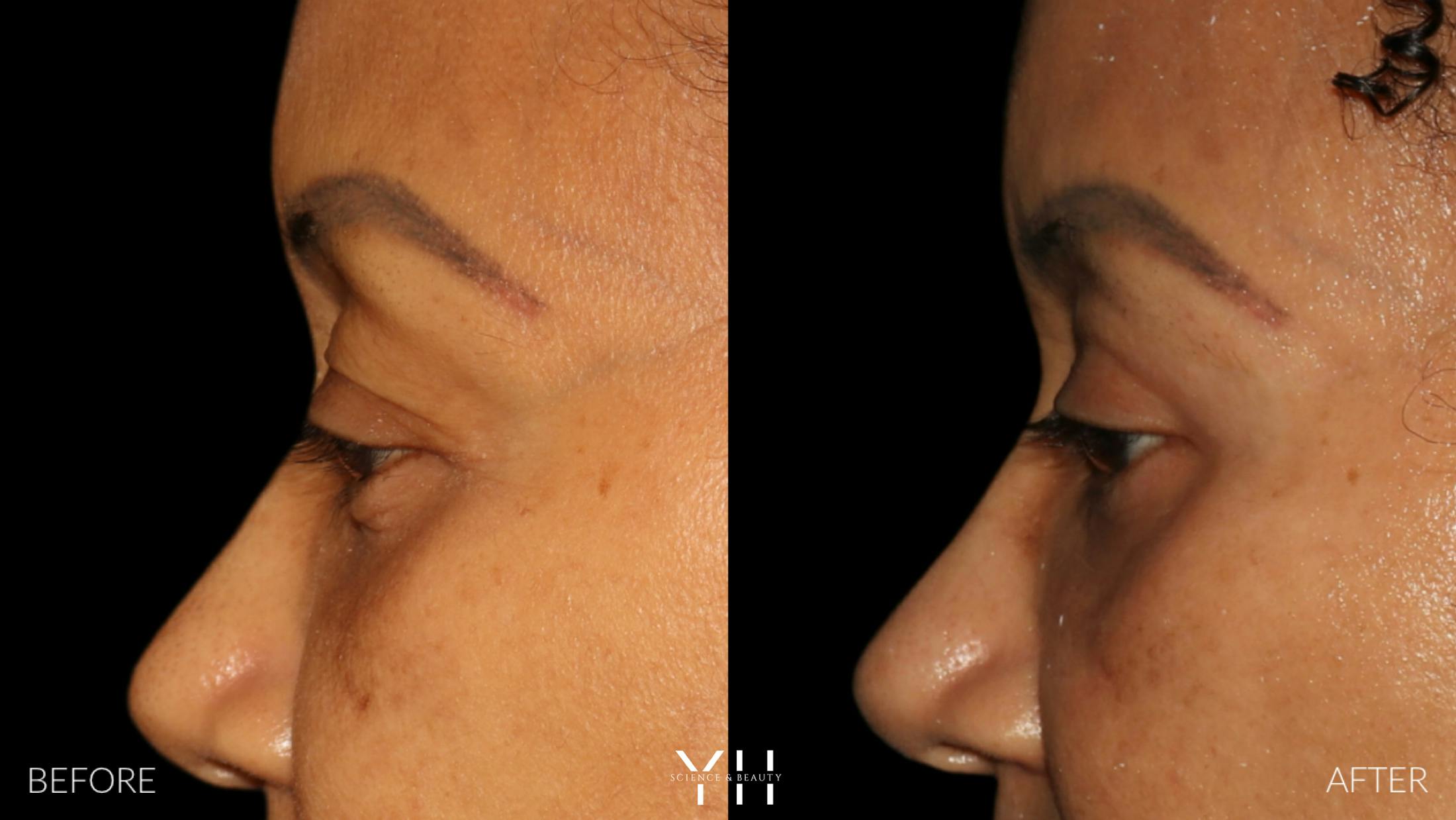 Blepharoplasty Before & After Gallery - Patient 746491 - Image 3