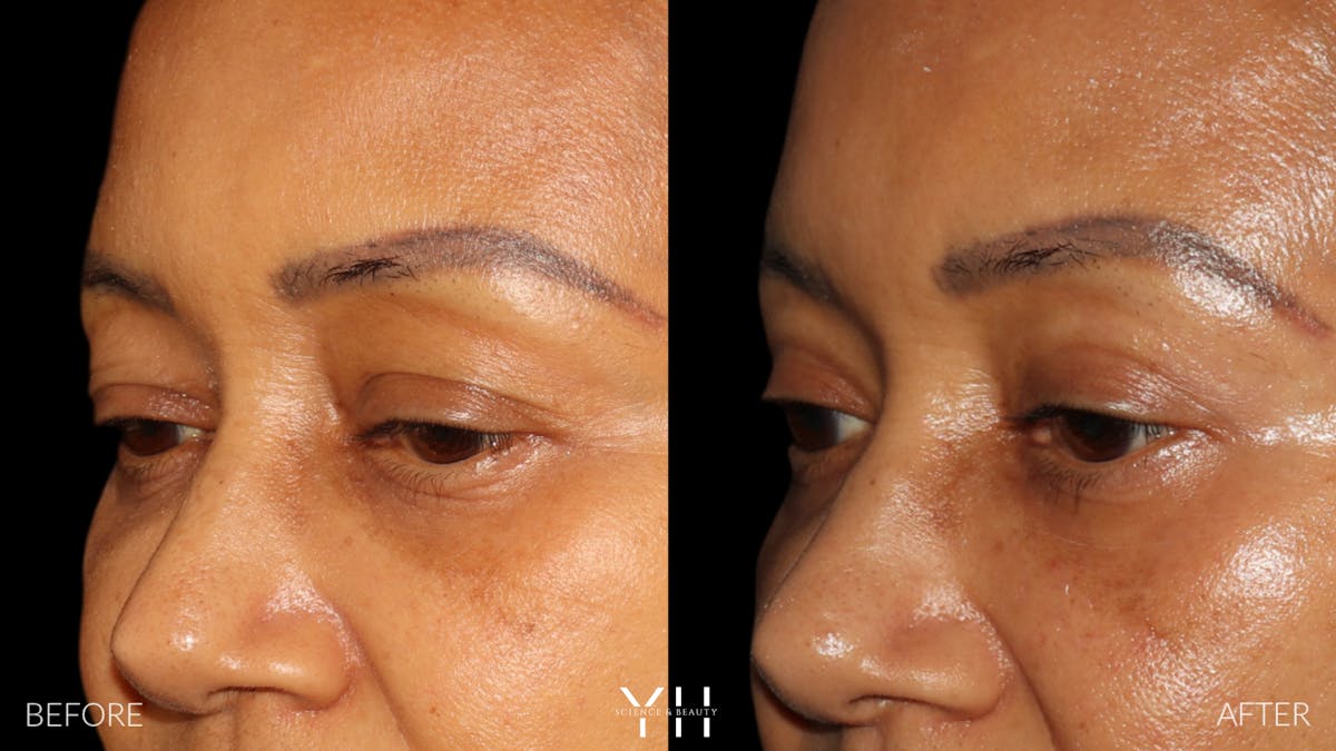  Blepharoplasty Before & After Gallery - Patient 746491 - Image 4