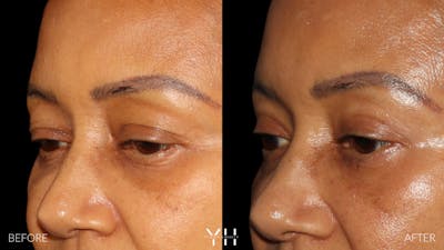  Blepharoplasty Before & After Gallery - Patient 746491 - Image 4