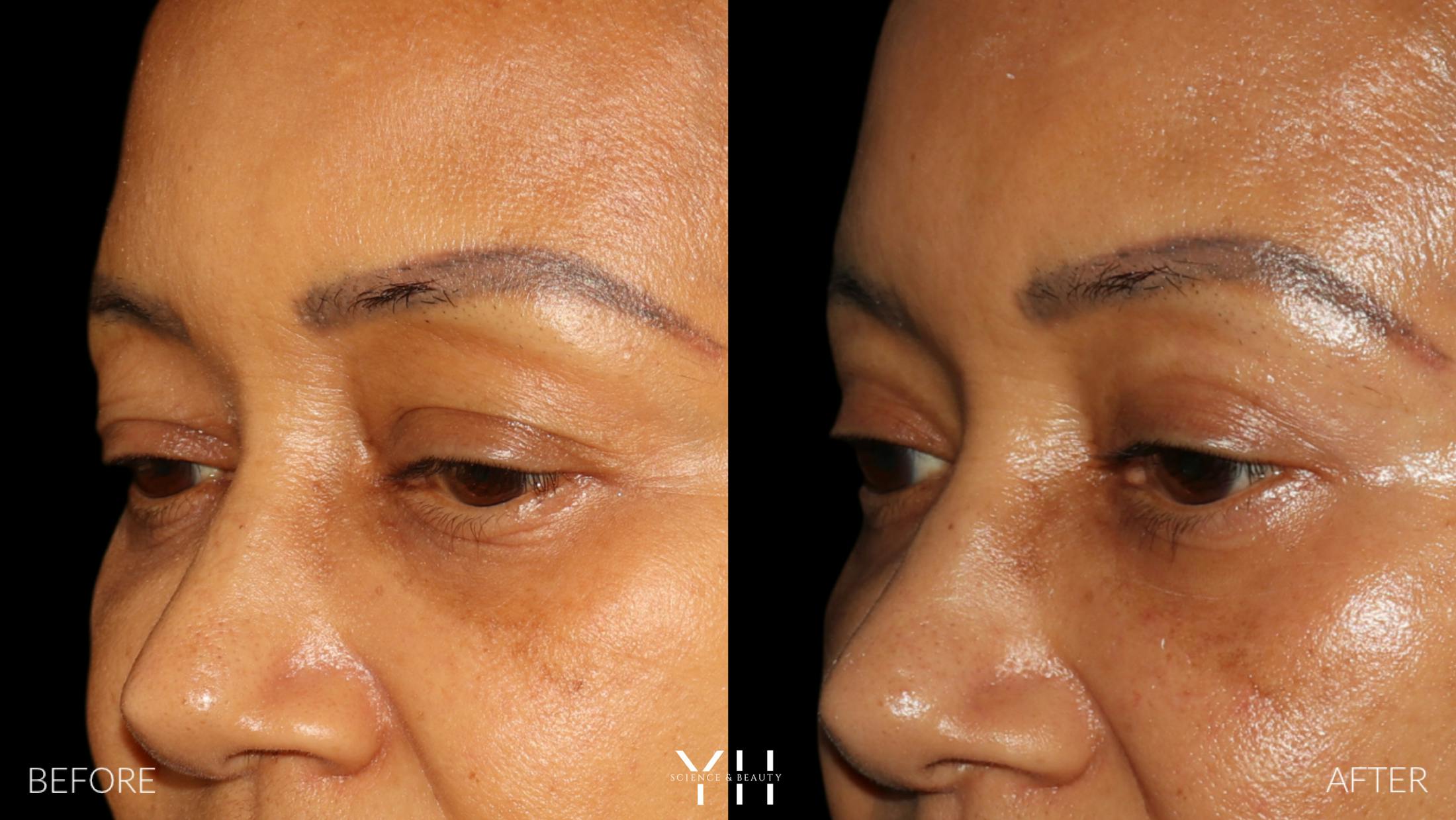 Blepharoplasty Before & After Gallery - Patient 746491 - Image 4