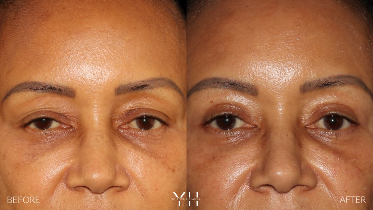  Blepharoplasty Before & After Gallery - Patient 746491 - Image 1