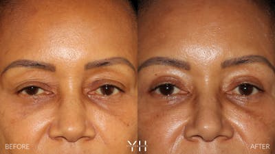  Blepharoplasty Before & After Gallery - Patient 746491 - Image 1