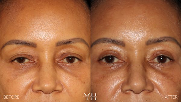  Blepharoplasty Before & After Gallery - Patient 746491 - Image 1