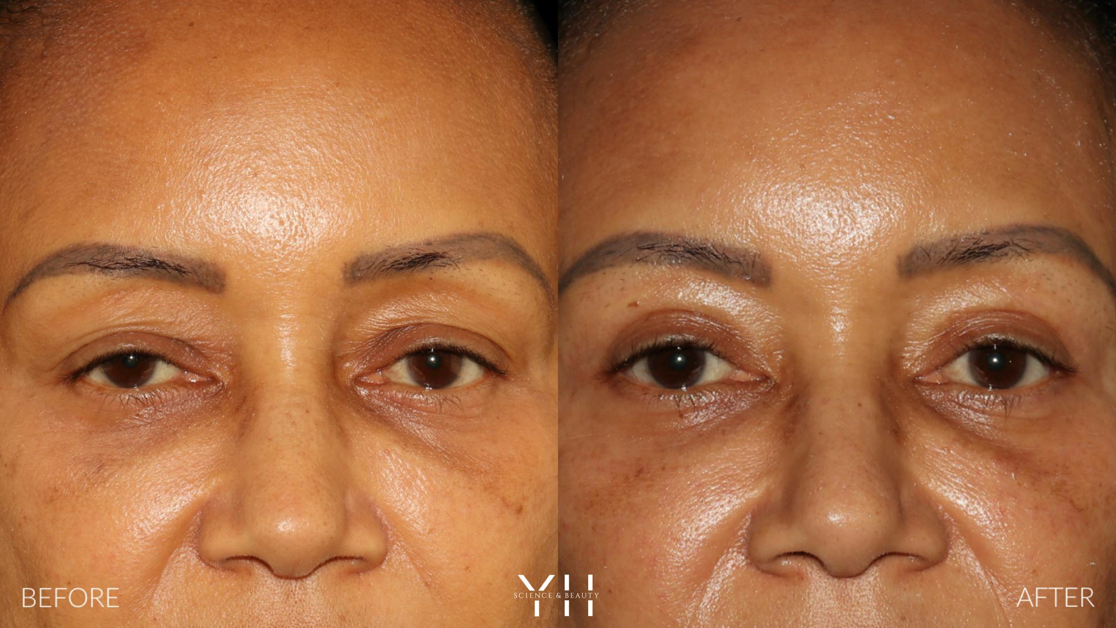 Blepharoplasty Before & After Gallery - Patient 746491 - Image 1
