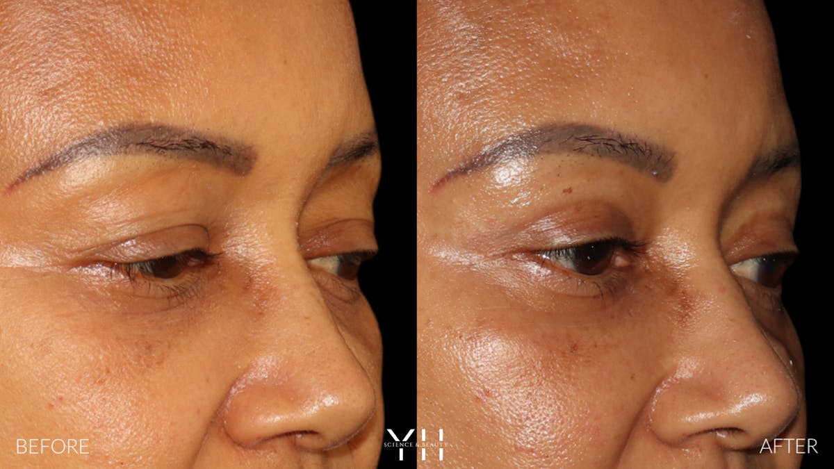 Blepharoplasty Before & After Gallery - Patient 746491 - Image 2
