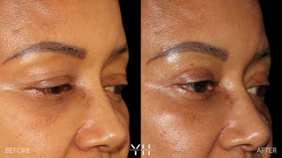  Blepharoplasty Before & After Gallery - Patient 746491 - Image 2