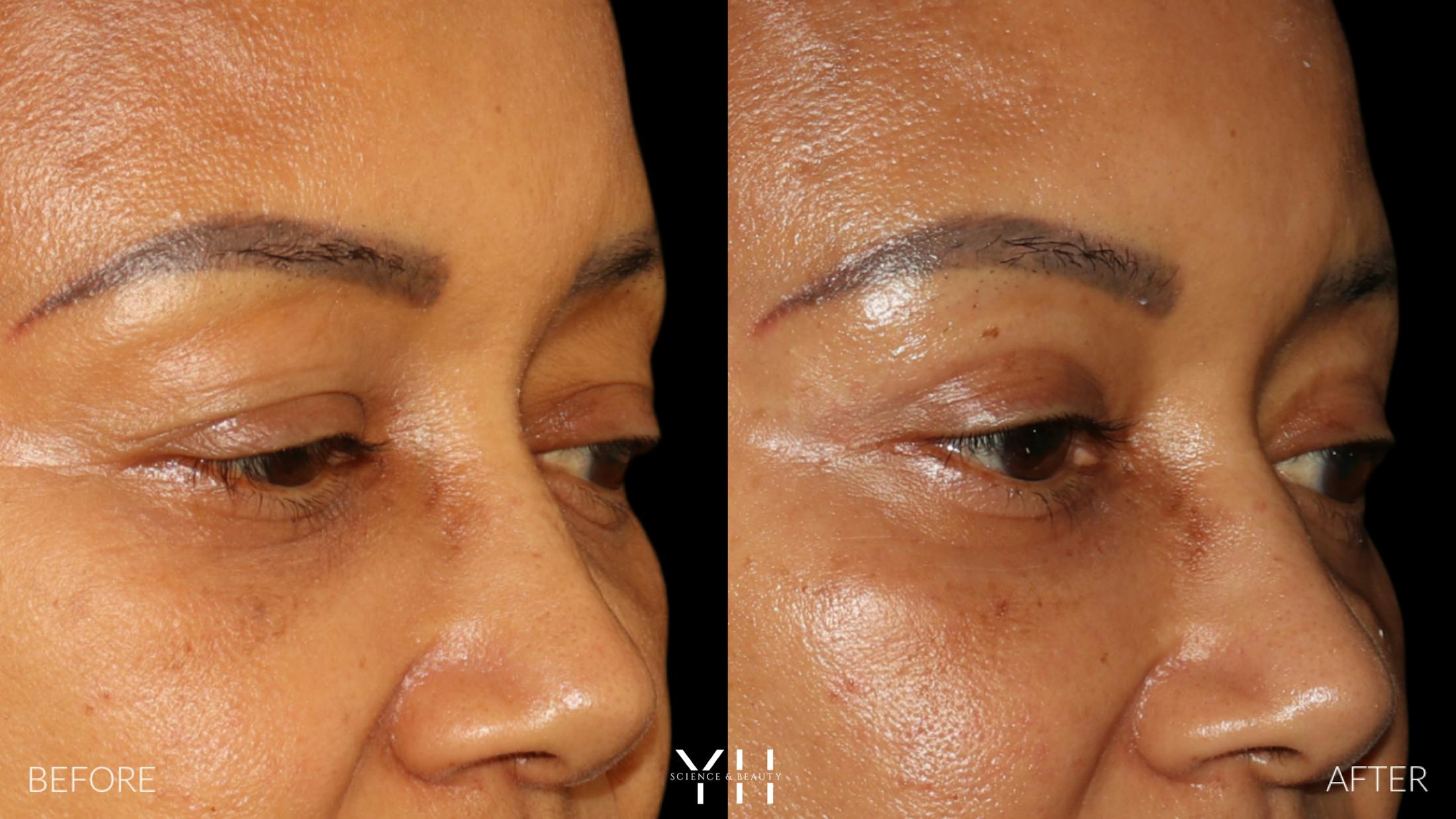 Blepharoplasty Before & After Gallery - Patient 746491 - Image 2