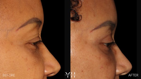  Blepharoplasty Before & After Gallery - Patient 746491 - Image 5