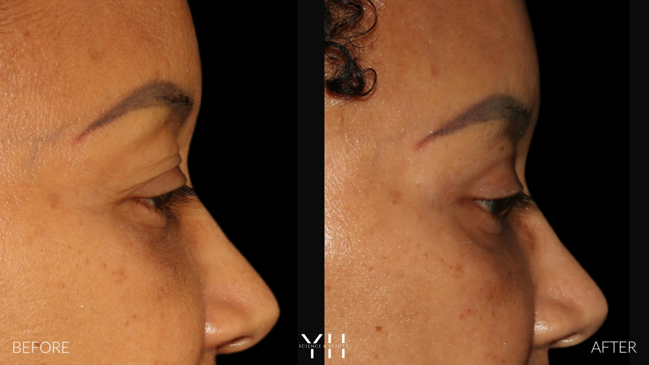 Blepharoplasty Before & After Gallery - Patient 746491 - Image 5