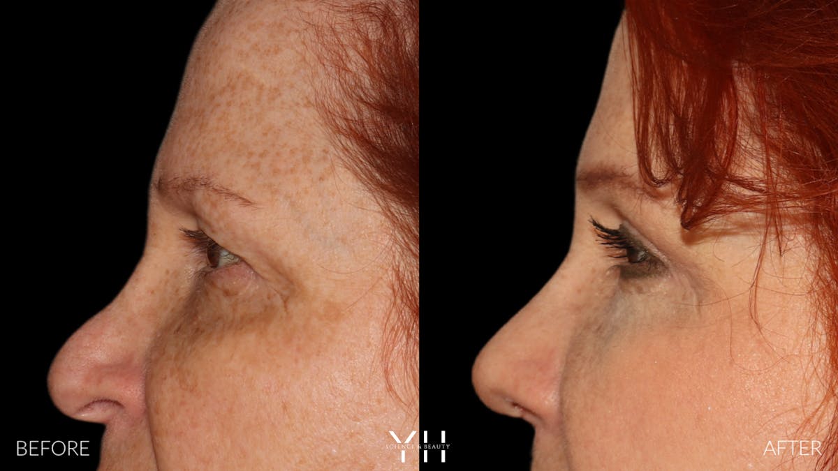  Blepharoplasty Before & After Gallery - Patient 124830 - Image 5