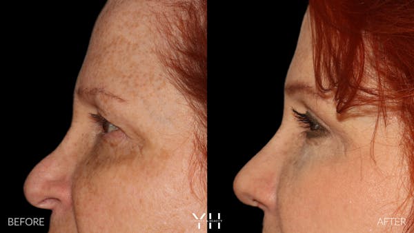  Blepharoplasty Before & After Gallery - Patient 124830 - Image 5