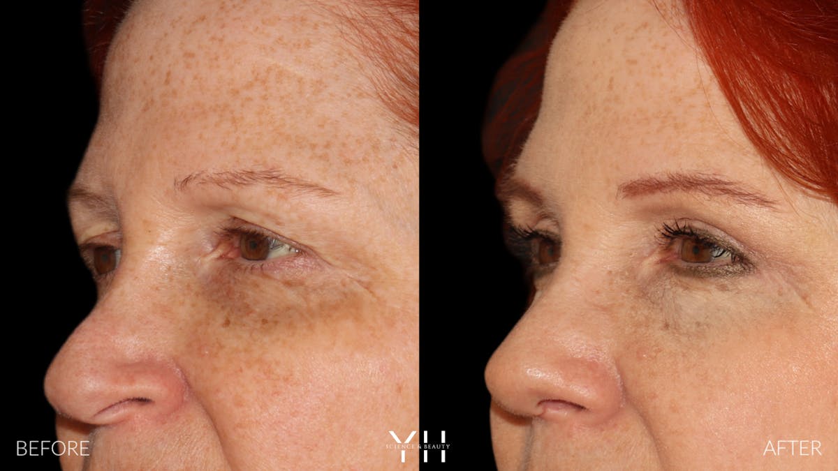  Blepharoplasty Before & After Gallery - Patient 124830 - Image 4