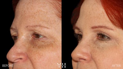  Blepharoplasty Before & After Gallery - Patient 124830 - Image 4