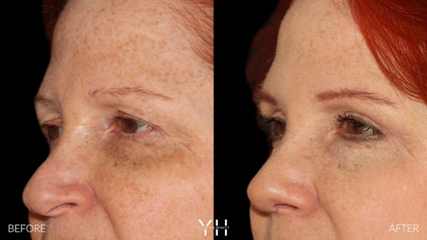 Blepharoplasty Before & After Gallery - Patient 124830 - Image 4