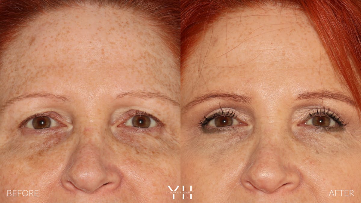  Blepharoplasty Before & After Gallery - Patient 124830 - Image 1