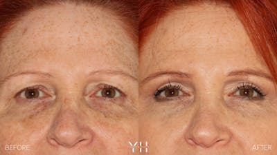  Blepharoplasty Before & After Gallery - Patient 124830 - Image 1