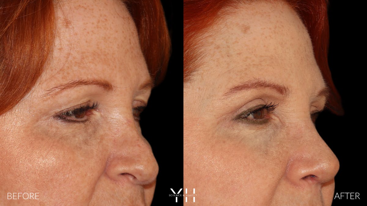  Blepharoplasty Before & After Gallery - Patient 124830 - Image 2
