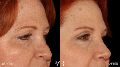  Blepharoplasty Before & After Gallery - Patient 124830 - Image 2