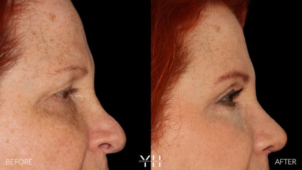  Blepharoplasty Before & After Gallery - Patient 124830 - Image 3