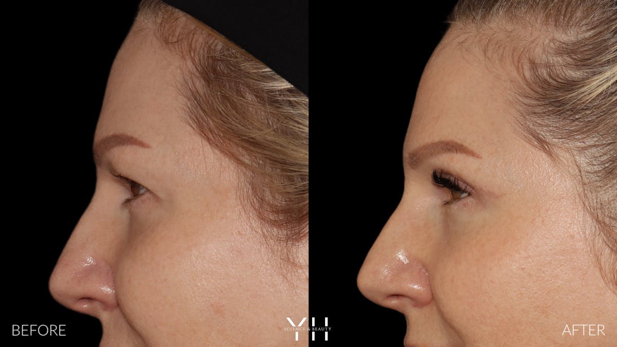  Blepharoplasty Before & After Gallery - Patient 401611 - Image 5
