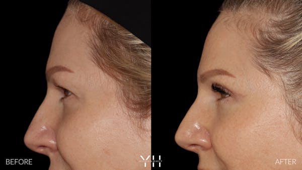  Blepharoplasty Before & After Gallery - Patient 401611 - Image 5