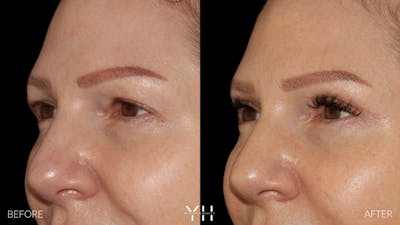  Blepharoplasty Before & After Gallery - Patient 401611 - Image 4