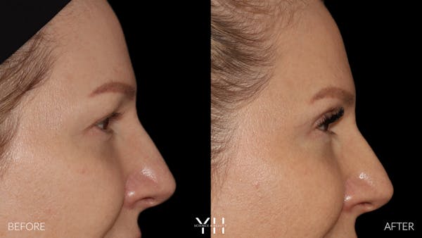  Blepharoplasty Before & After Gallery - Patient 401611 - Image 3