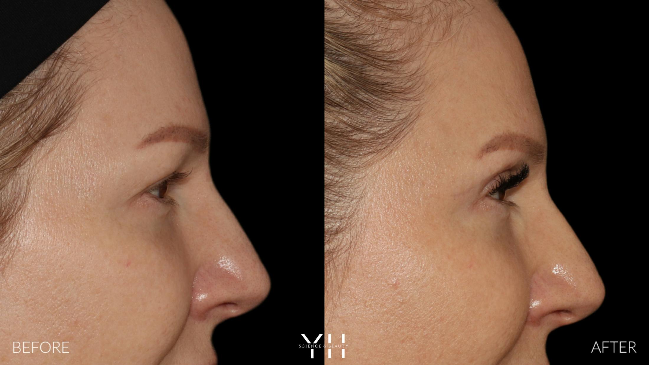 Blepharoplasty Before & After Gallery - Patient 401611 - Image 3