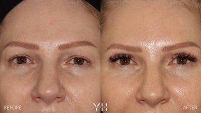  Blepharoplasty Before & After Gallery - Patient 401611 - Image 1