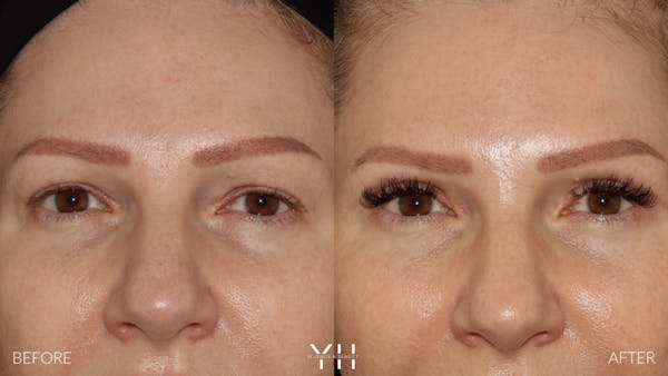 Blepharoplasty Before & After Gallery - Patient 401611 - Image 1