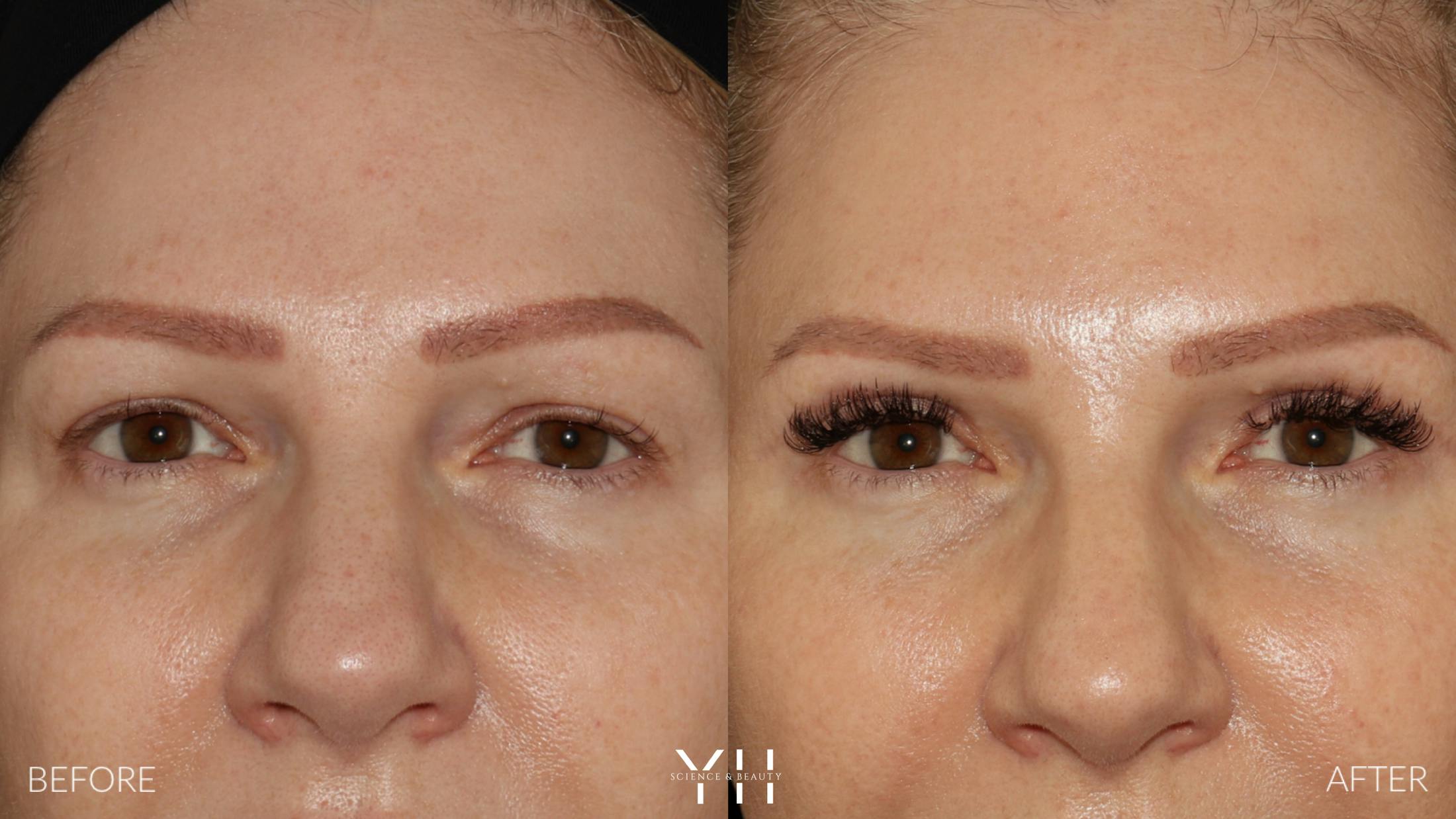 Blepharoplasty Before & After Gallery - Patient 401611 - Image 1