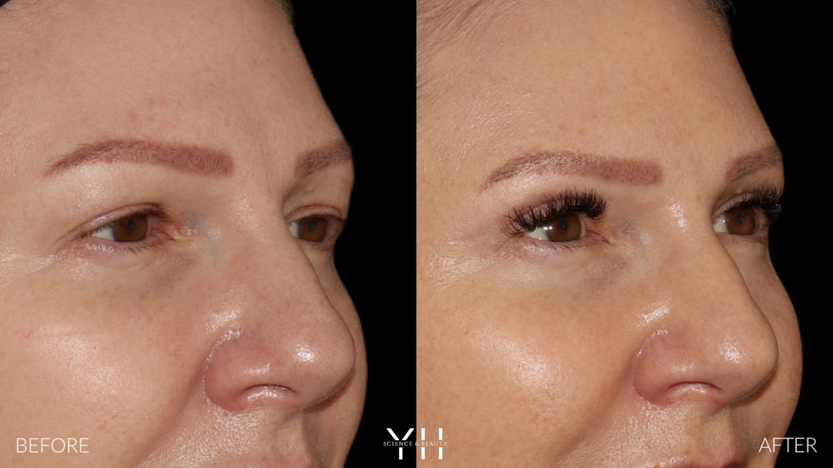  Blepharoplasty Before & After Gallery - Patient 401611 - Image 2