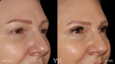  Blepharoplasty Before & After Gallery - Patient 401611 - Image 2