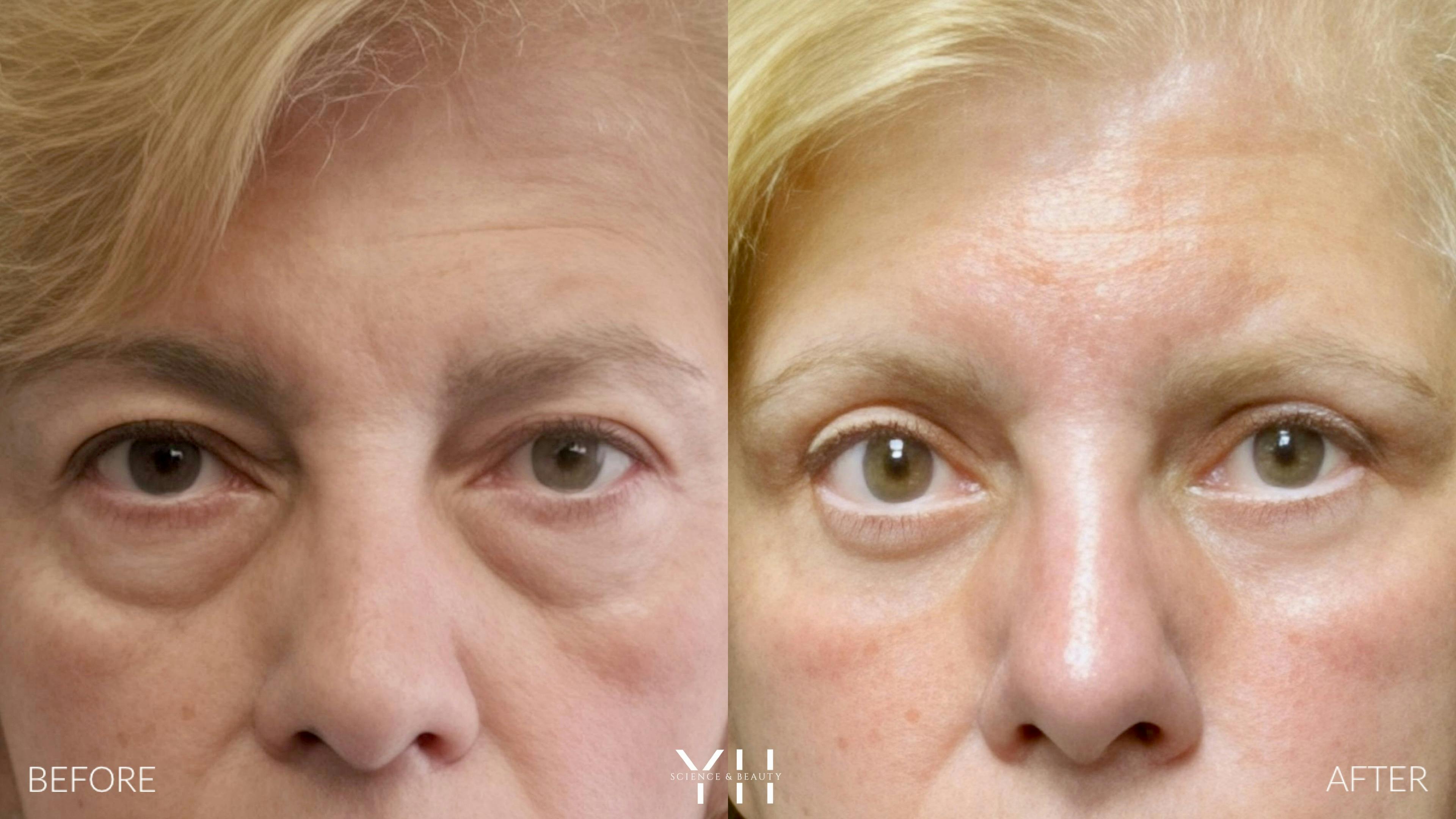Before and After Eyelid Surgery