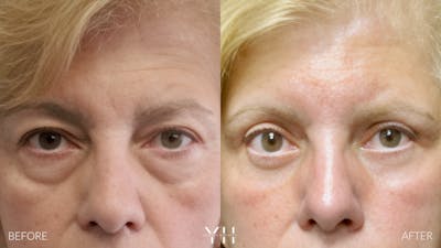  Blepharoplasty Before & After Gallery - Patient 138359 - Image 1