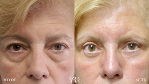  Blepharoplasty Before & After Gallery - Patient 138359 - Image 1