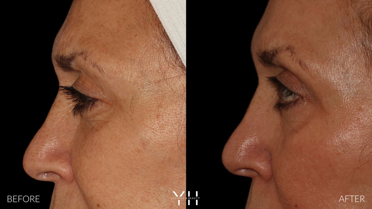  Blepharoplasty Before & After Gallery - Patient 121670069 - Image 5