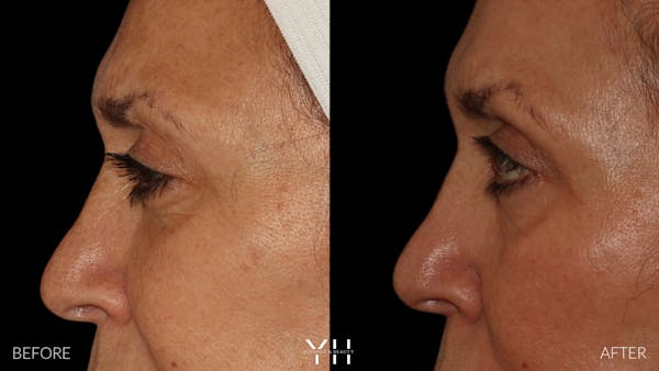  Blepharoplasty Before & After Gallery - Patient 121670069 - Image 5