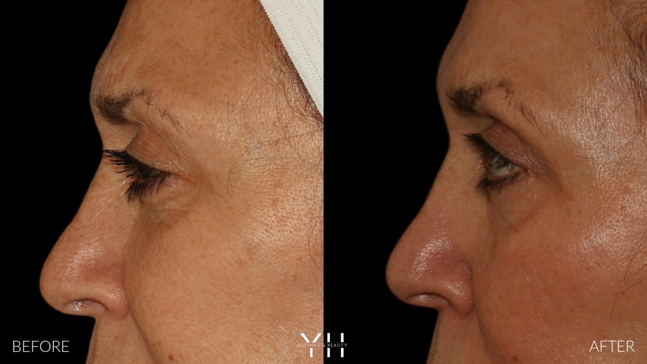 Blepharoplasty Before & After Gallery - Patient 121670069 - Image 5