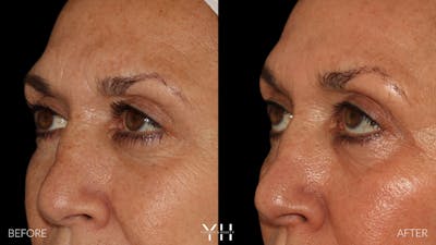 Blepharoplasty Before & After Gallery - Patient 121670069 - Image 4
