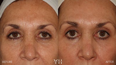  Blepharoplasty Before & After Gallery - Patient 121670069 - Image 1