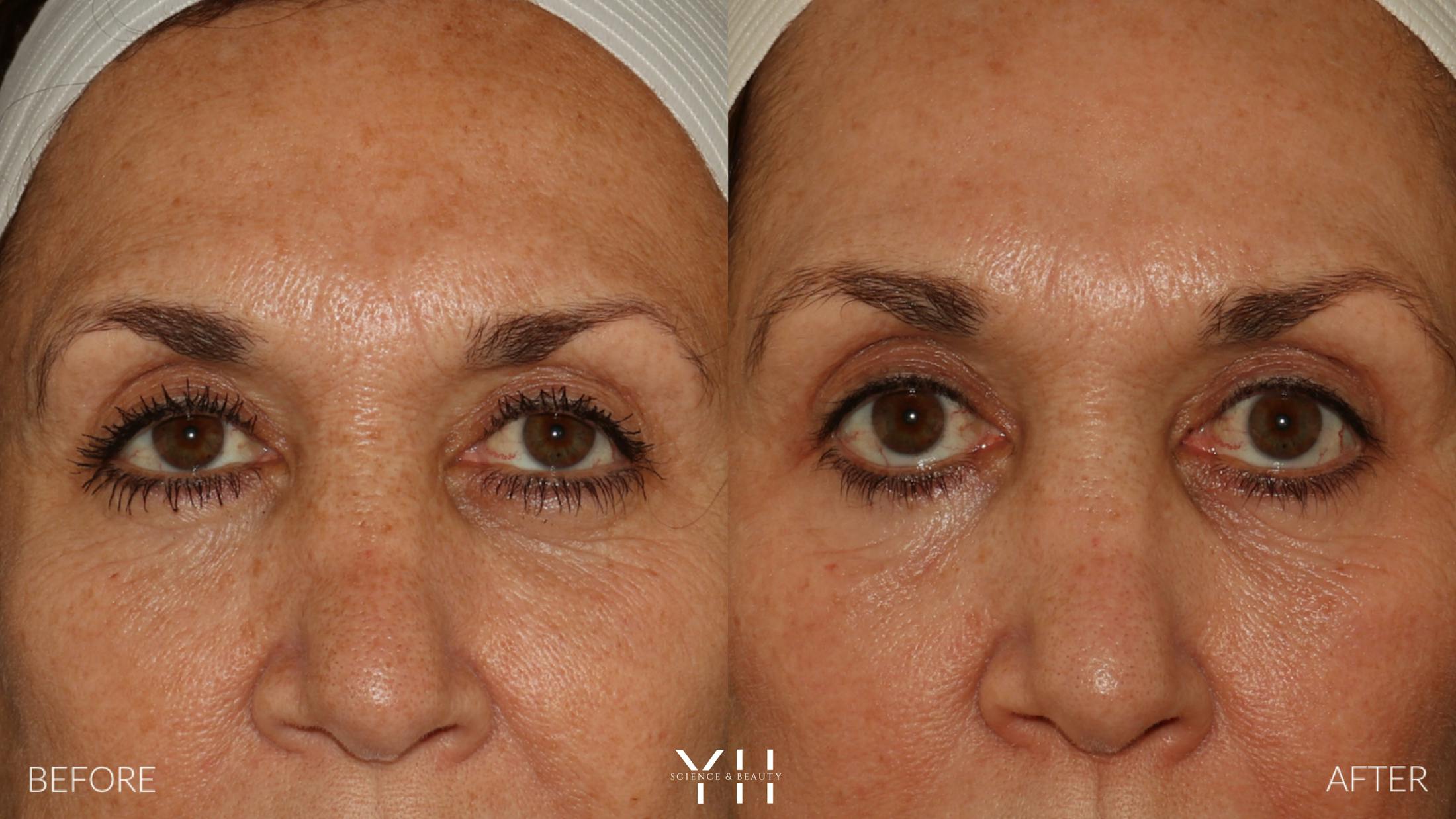 Blepharoplasty Before & After Gallery - Patient 121670069 - Image 1