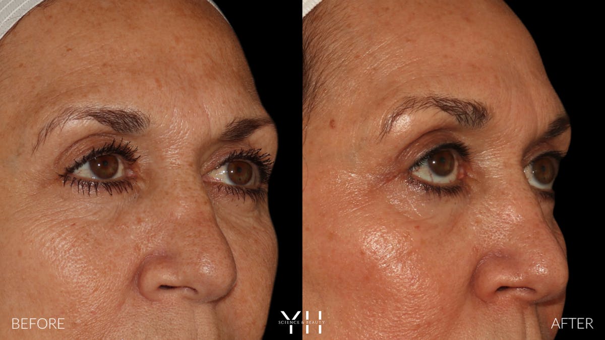  Blepharoplasty Before & After Gallery - Patient 121670069 - Image 2