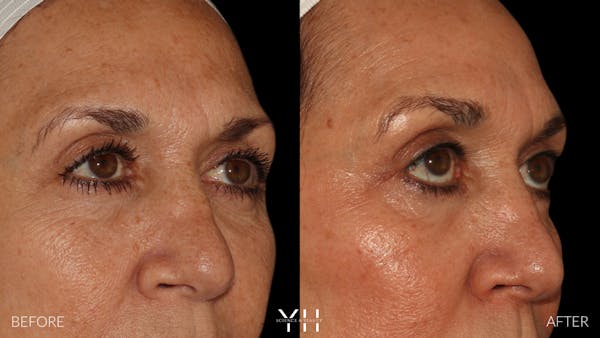  Blepharoplasty Before & After Gallery - Patient 121670069 - Image 2