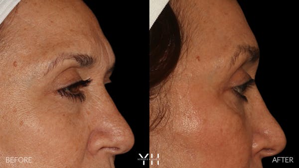  Blepharoplasty Before & After Gallery - Patient 121670069 - Image 3